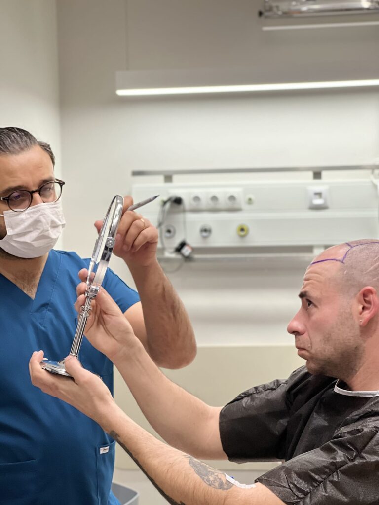 Doctor marca la linea frontal con el paciente antes del injerto capilar en Estambul